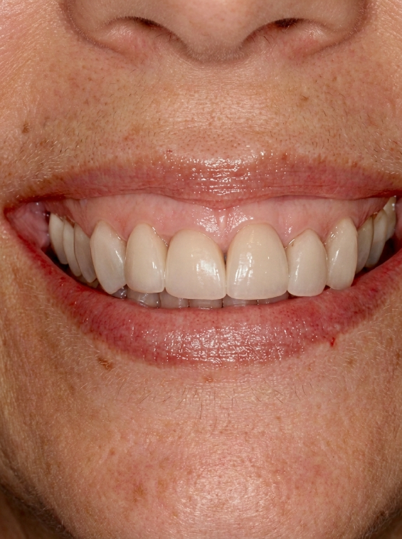 Gum Contouring / Gummy Smile Correction